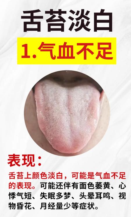 从舌苔看健康：5种舌象对应不同身体状况