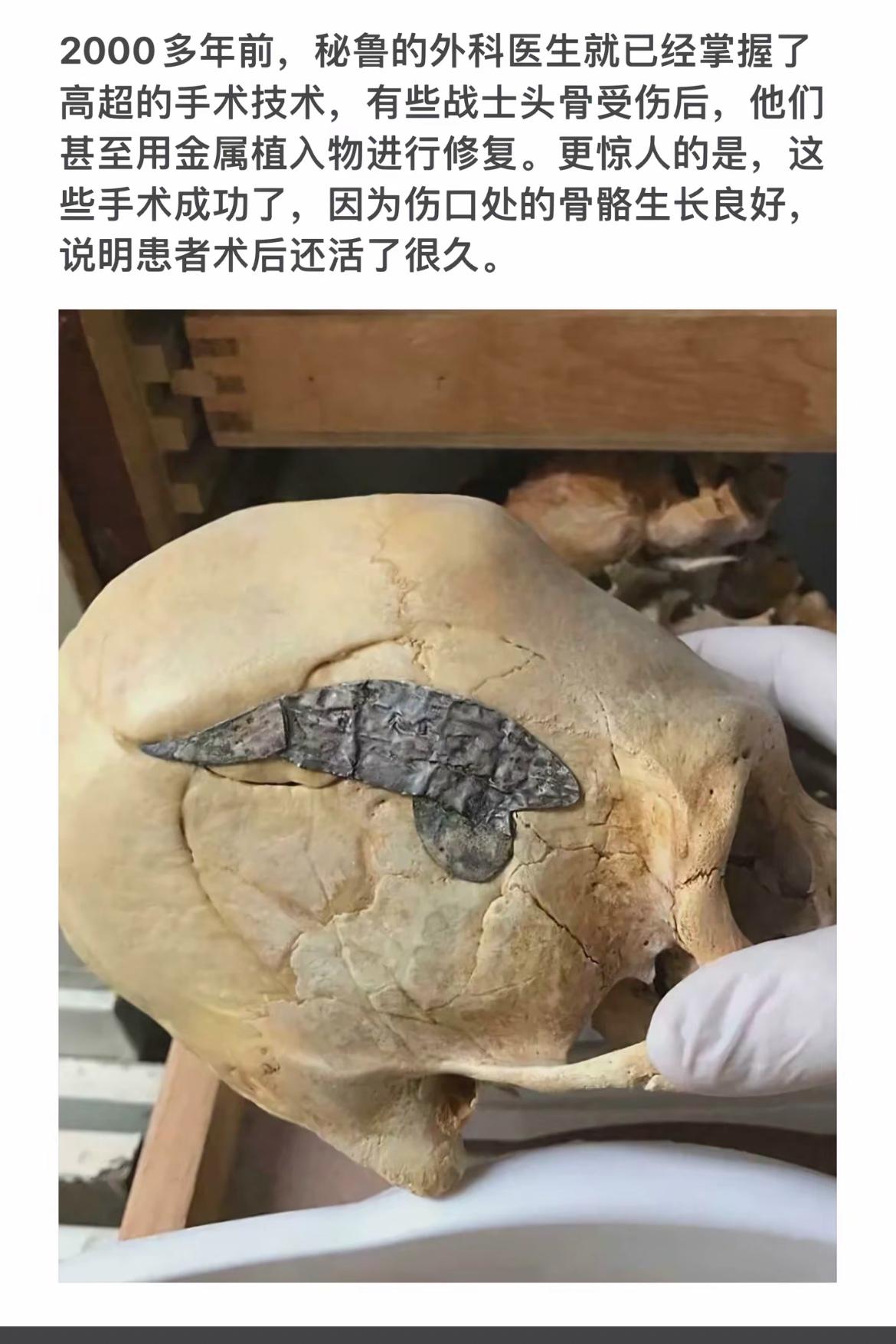 秘鲁外科高超，金属植入骨愈。