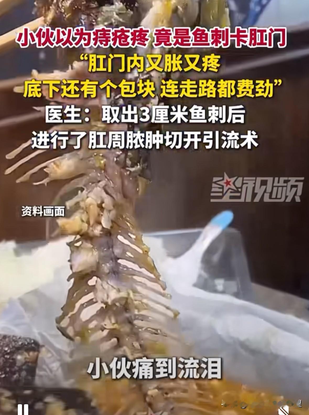 “危险还是发生了”！广东，28岁男子几天前，突然觉得肛门内又胀又痛，以为是痔疮上