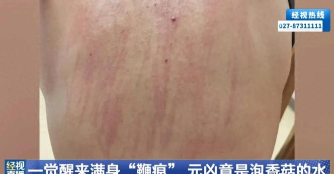 “长见识了！”武汉，一名68岁的老人遇上了一桩怪事，他一觉醒来浑身布满条状红痕，