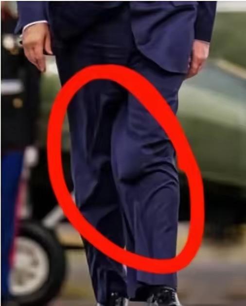 《纽约邮报》：“多名医疗从业者指出，该轮廓与便携式尿袋高度吻合”。消息真假无