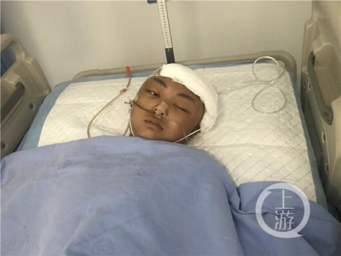 找来了正在值班的神经外科3名医生连夜进行开颅手术