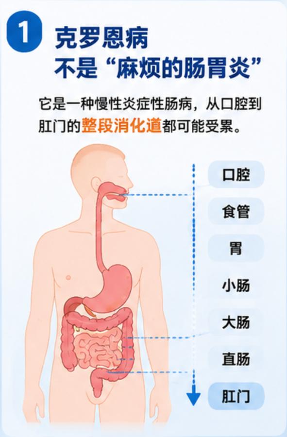 【控制克罗恩病，很多人漏掉了这件事】不明原因腹泻小心克罗恩病世界炎症性肠病日