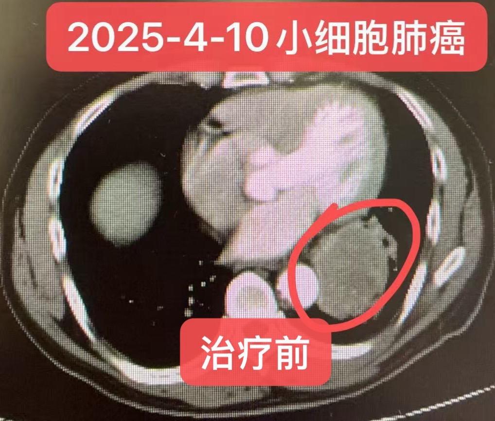 小细胞肺癌挽救治疗：个案分享。小细胞肺癌挽救治疗个案分享（非普适性方案...