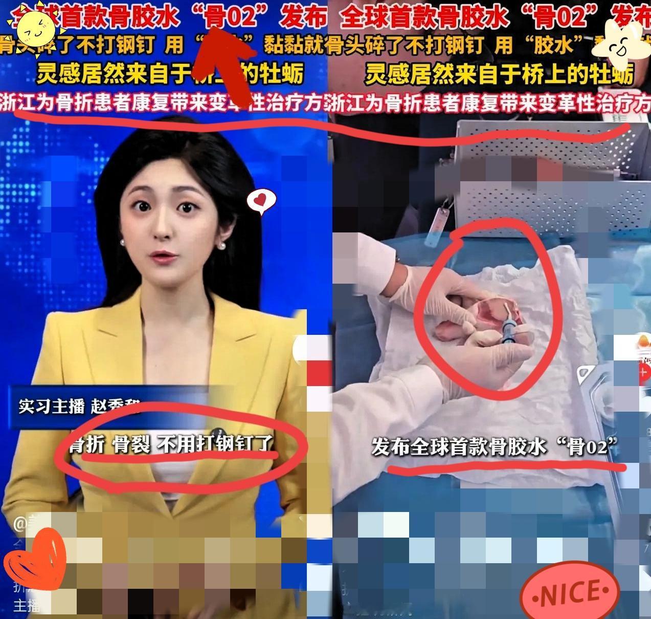 浙江这波操作太牛！谁能想到？浙江邵逸夫医院搞出个大动静，全球首款骨胶水
