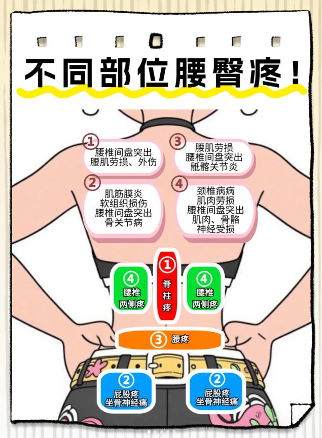 🙌4 个部位腰疼自查！腰臀痛原因全解析 久坐星人看过来！不同部位的腰...