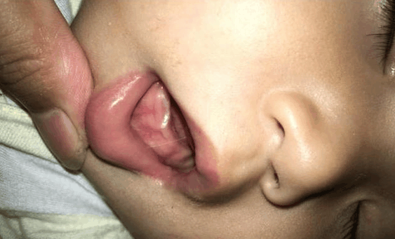 宝宝爱吐舌头, 婆婆说是调皮, 医生说了三个字