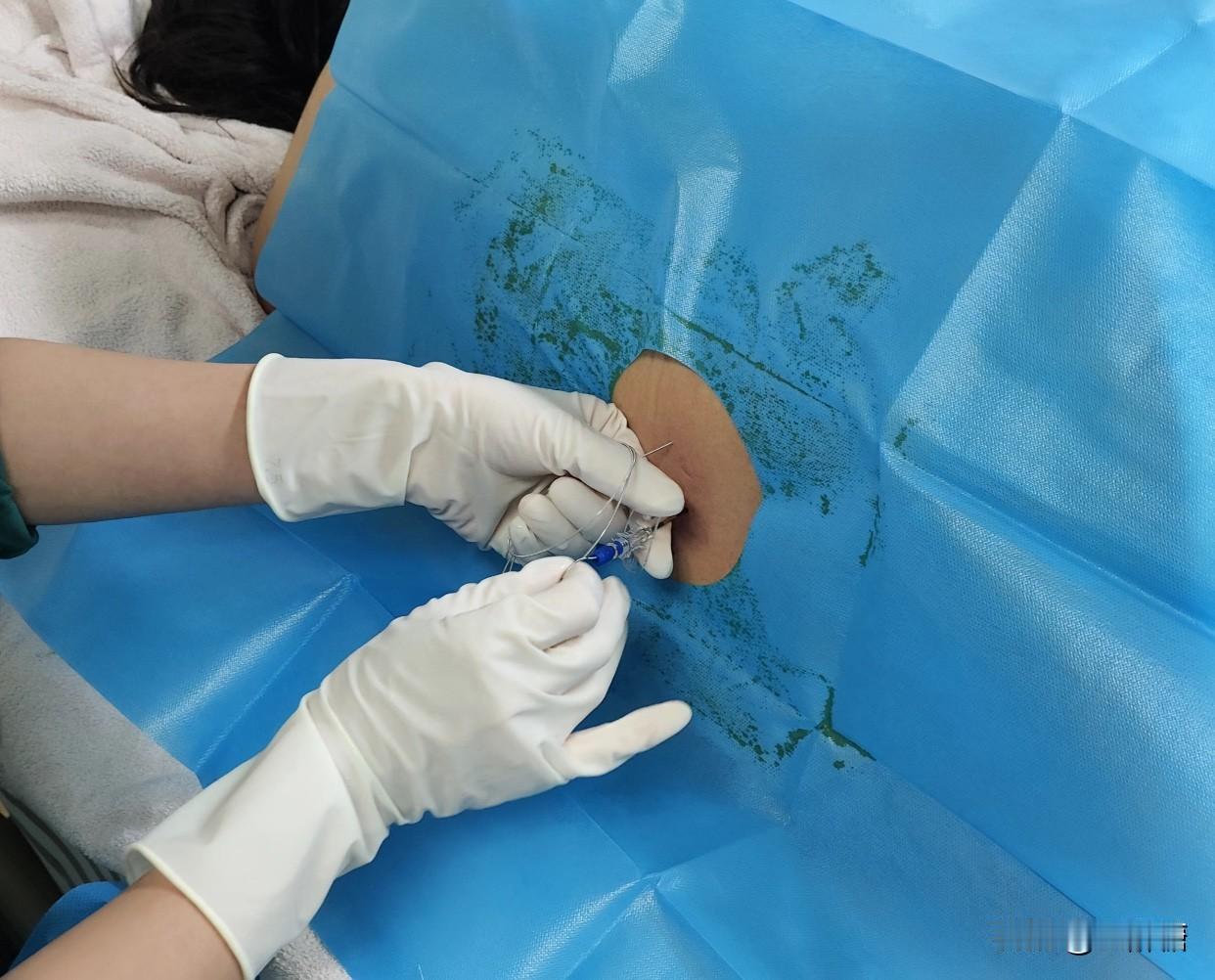 顺产生孩子，无痛分娩，你们打过吗？我第一胎就打了无痛分娩，我这个人很怕痛