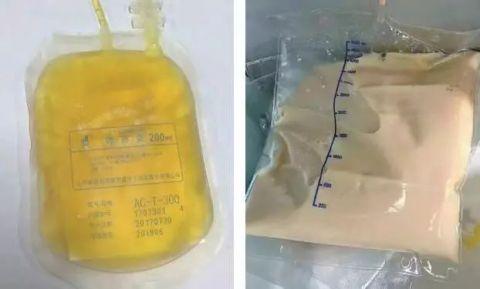 27岁姑娘血浆竟变乳白色! 这4样东西劝你别吃了
