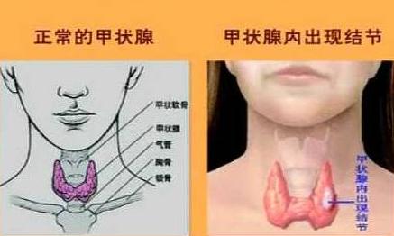 体检查出甲狀腺结节就等于判“癌”?別再白慌了!体检报告上出现“甲状腺结节”几
