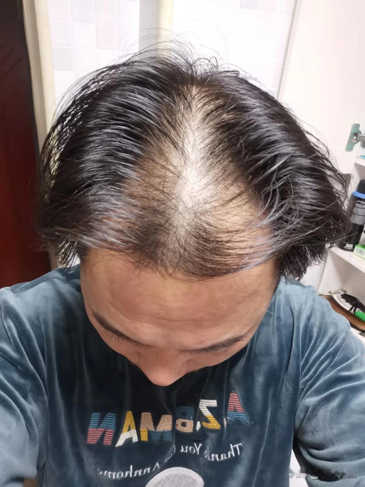 短短三年时间就脱发成这个样子了，看样子非常严重，预计几年后就秃了，学医之前头发还