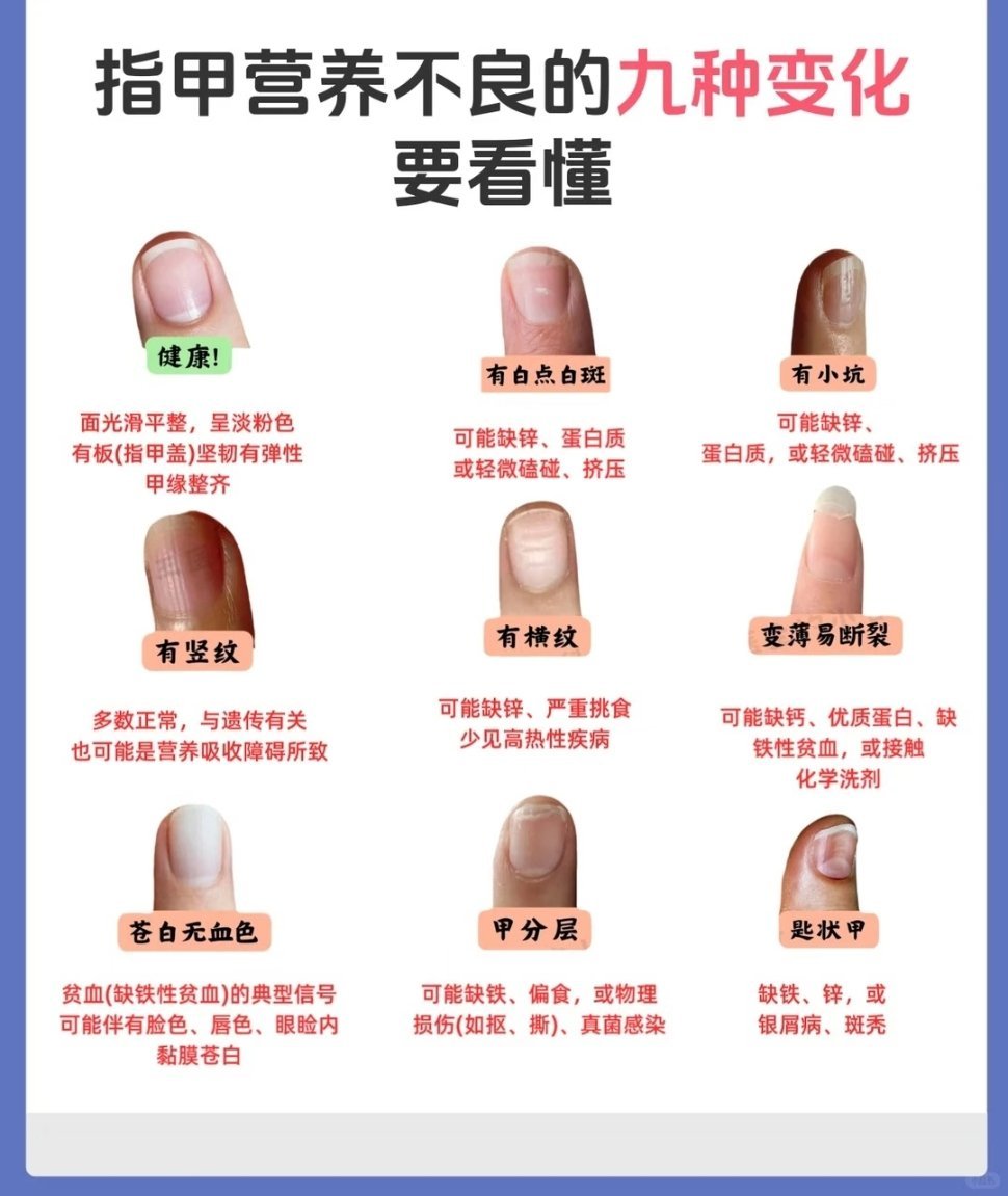 指甲上有竖棱代表肝血不足警惕！这些指甲变化需就医虽然多数竖纹无碍，但如果指甲出