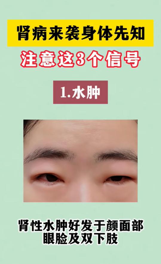 肾病来临的3个信号：水肿、泡沫尿、血尿要多留意