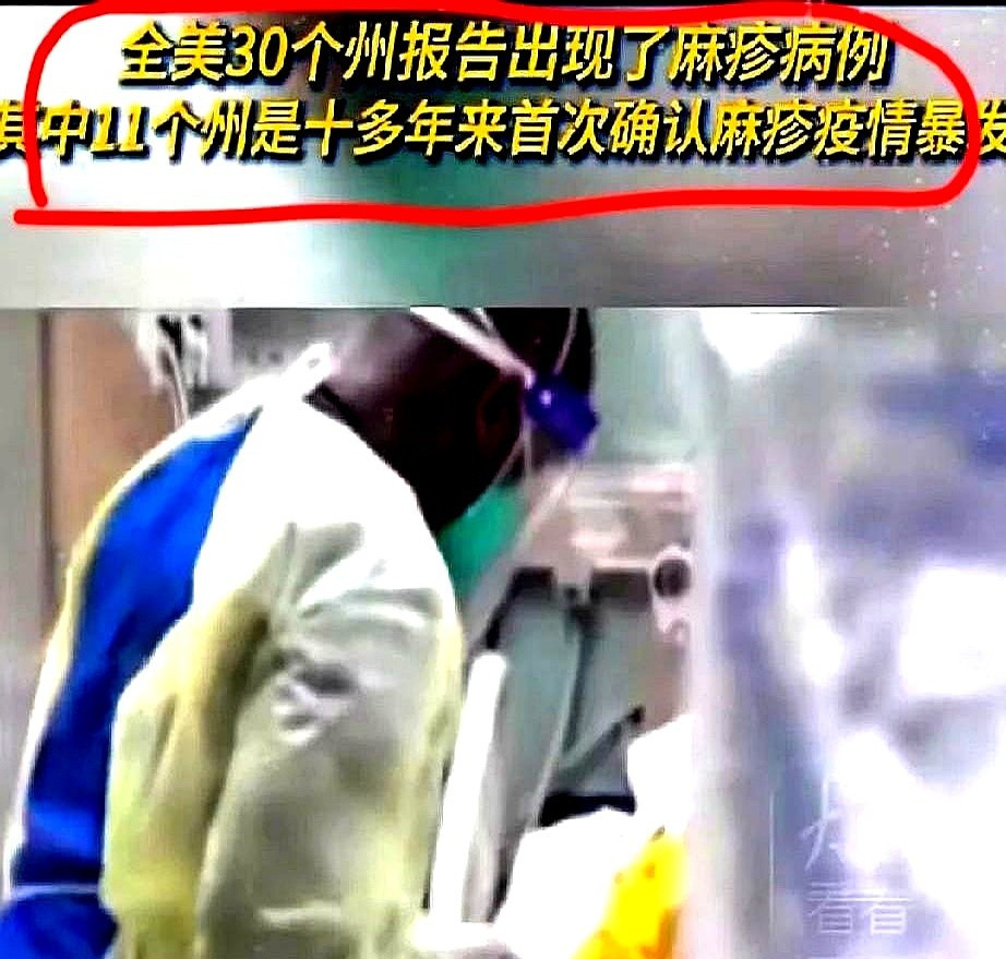 美国麻疹大爆发，这下要完蛋！嘿，小伙伴们，你们听说了吗？