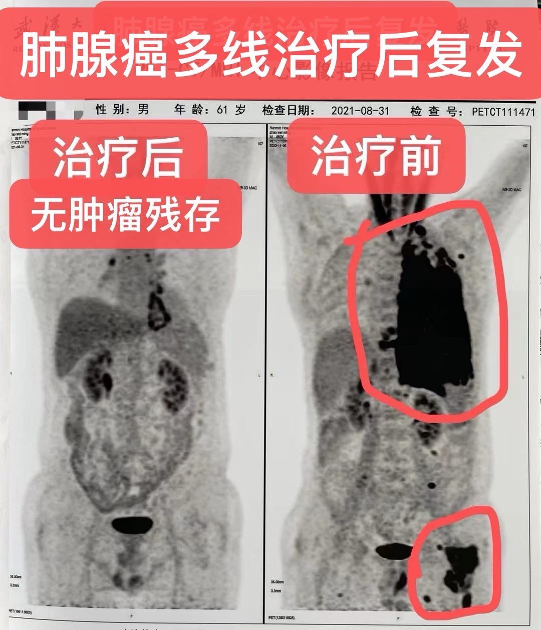 晚期-肺腺癌多线治疗后复发。男，61岁，肺腺癌多线治疗后，广泛转移！基...