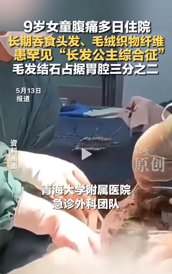 9岁女童因持续腹痛住院，胃腔三分之二被毛发结石，确诊“长发公主综合征”。 女