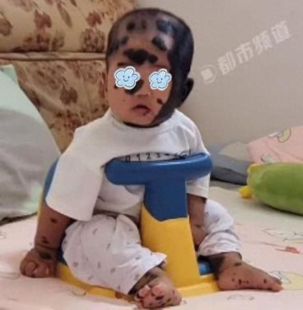 11月11日，一则“宝宝产检正常，出生后满身兽皮痣”的消息登上热搜。一位河南母亲