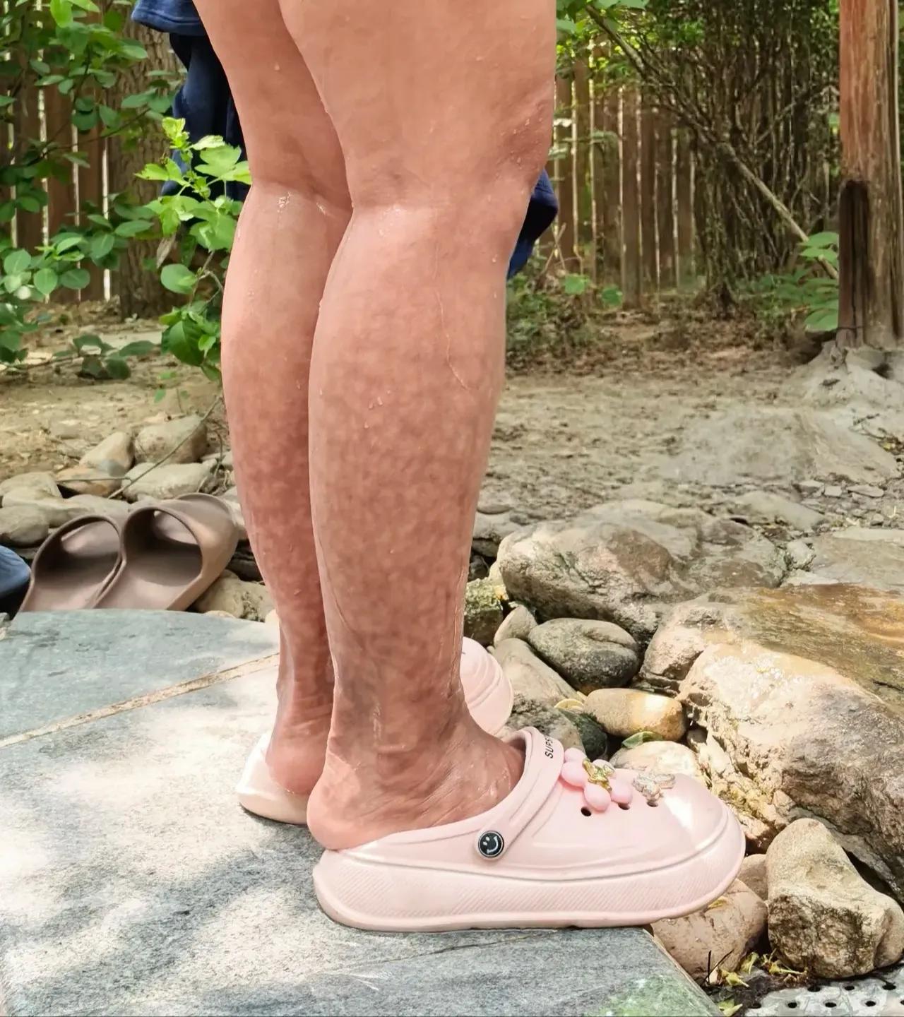 这是一位天天泡温泉的人的腿，皮肤都烫成这样了，还每天乐此不彼，哪位懂得泡温泉，泡