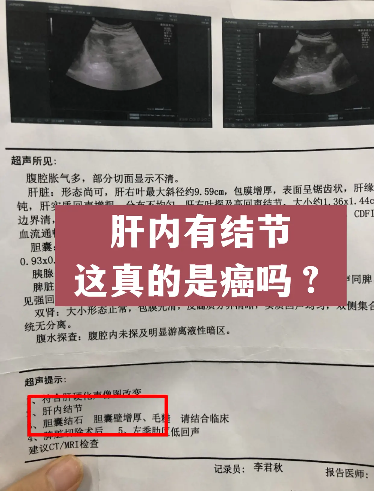47 岁的李先生找到我，肝脏彩超提示肝右叶有高回声结节，一个多公分。拿...