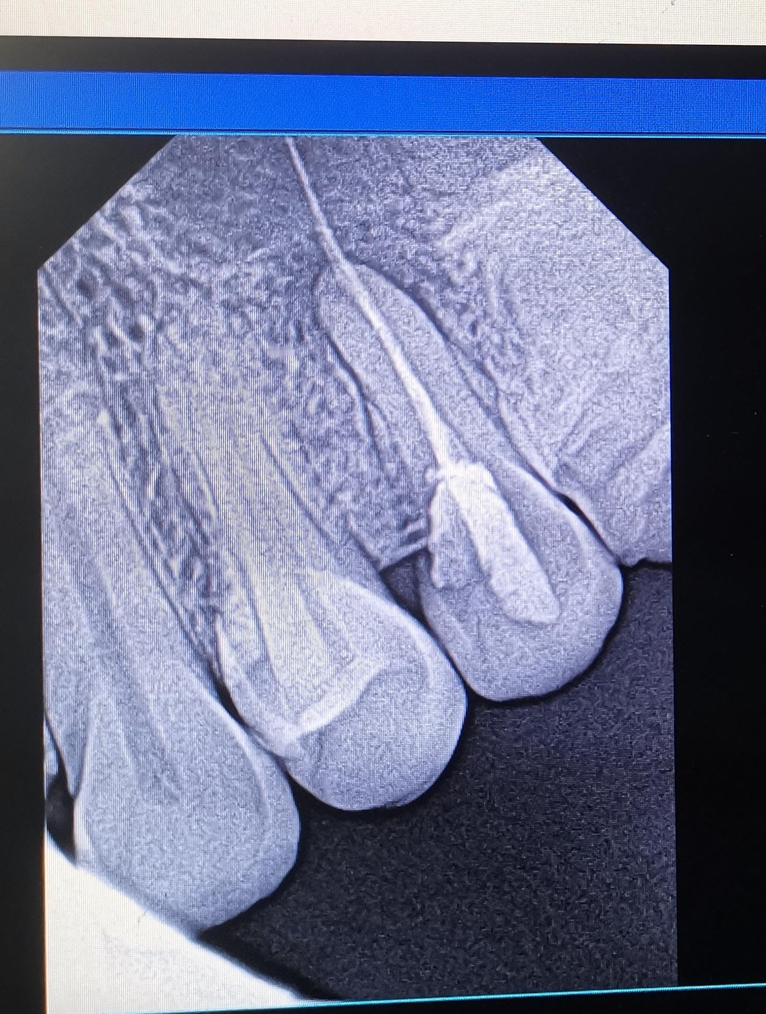 接一例转诊，急性上颌窦炎，发热。两个月前在一诊所做过根管治疗。我问，当时医生拍