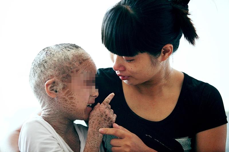 癌症引发的痒和普通皮肤痒可不一样，它往往是体内病变的信号。像淋巴瘤能引起全身性瘙