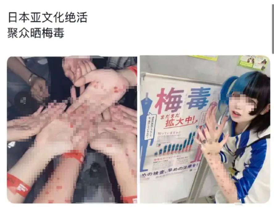 日本梅毒扩散2025年感染1.3万例。男性占2/3，主要为20-60岁；女性占1