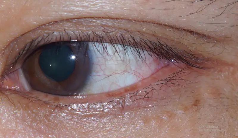 蚊子飞进眼睛，男子揉眼后差点失明，确诊为真菌性角膜溃疡视力仅剩0.04，医