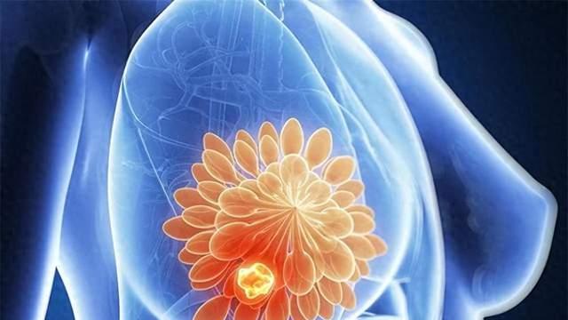 哺乳期乳房出现硬块、胀痛, 别只当堵奶, 乳腺炎久拖容易脓肿破溃