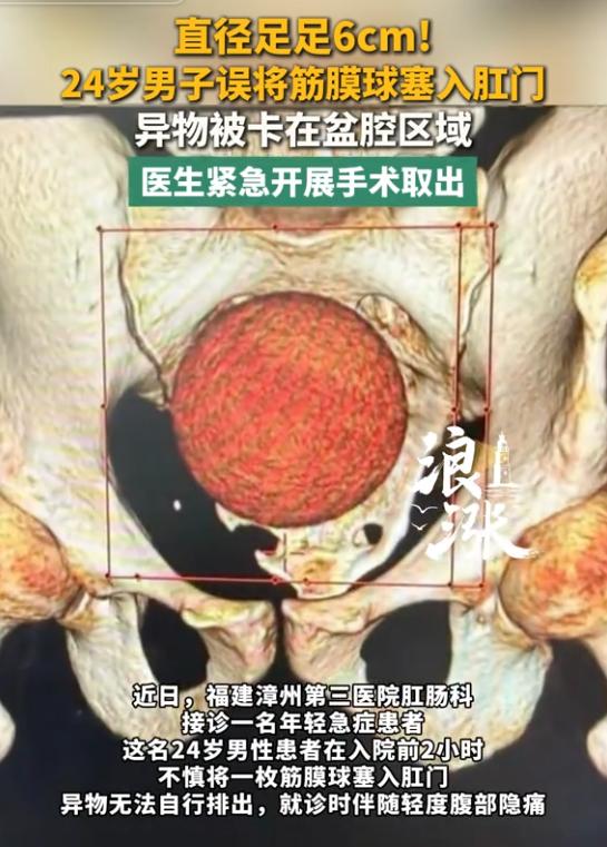 “丢人丢大了！”8月17日报道，福建漳州，一男子不小心，将一枚筋膜球塞入肛门里面
