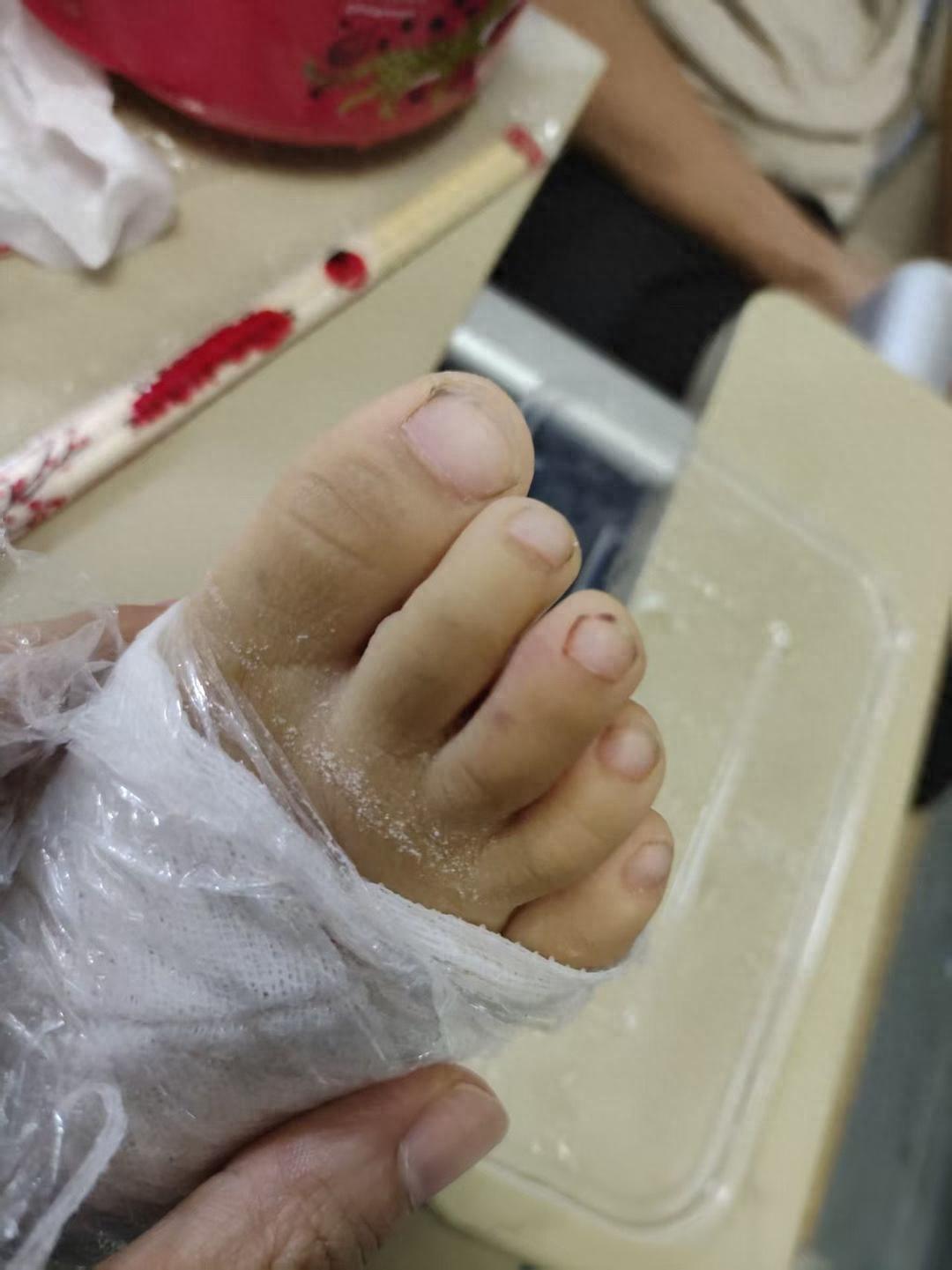 太揪心了！福建，一名4岁小女孩在家里一楼玩耍，一个没注意就被毒蛇咬伤，家人将蛇捕