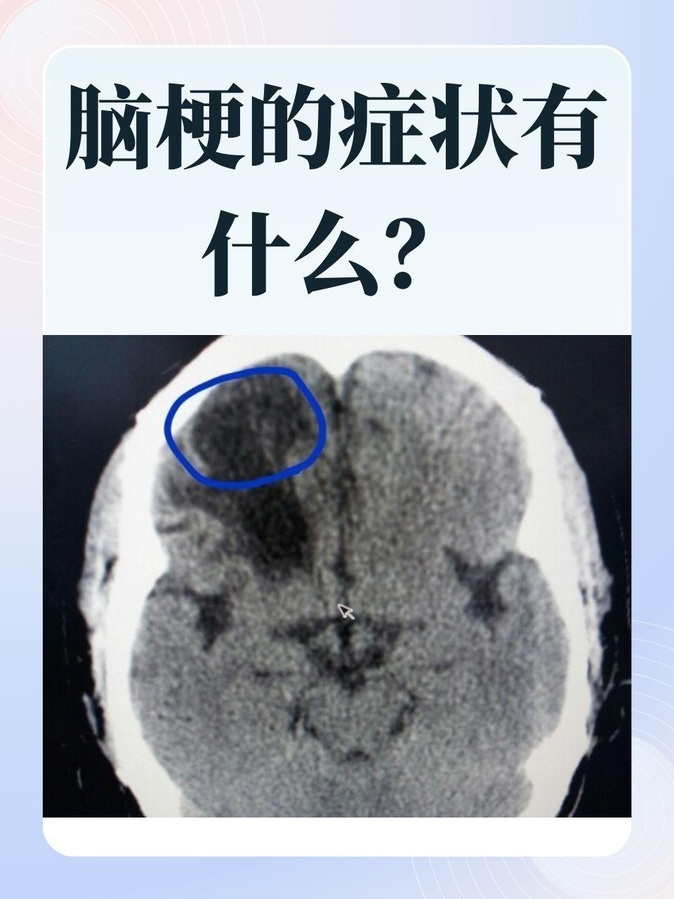 脑梗不是“突然”来的！这6个习惯，正偷偷给血管添堵你身边有没有这样的人：昨天