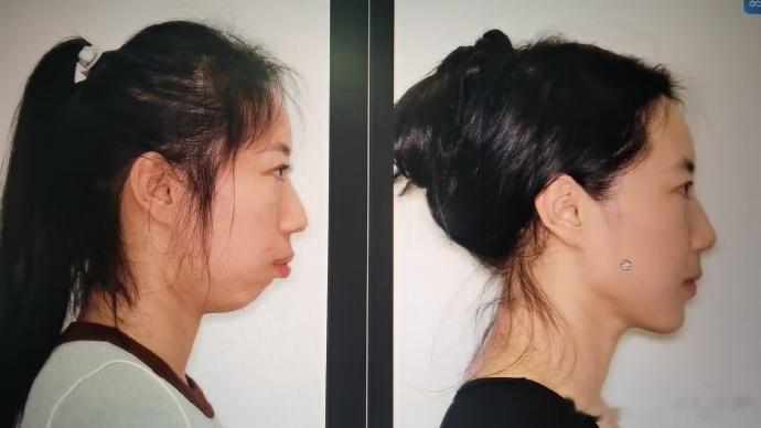 骨性突嘴这个东西，真的属于很多人意识不到会牵连整张脸一辈子的结构秩序。哪怕明明眼