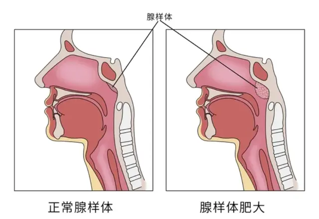 孩子腺样体肥大出现鼻塞、鼻涕倒流, 调理一个月家长称开始信中医