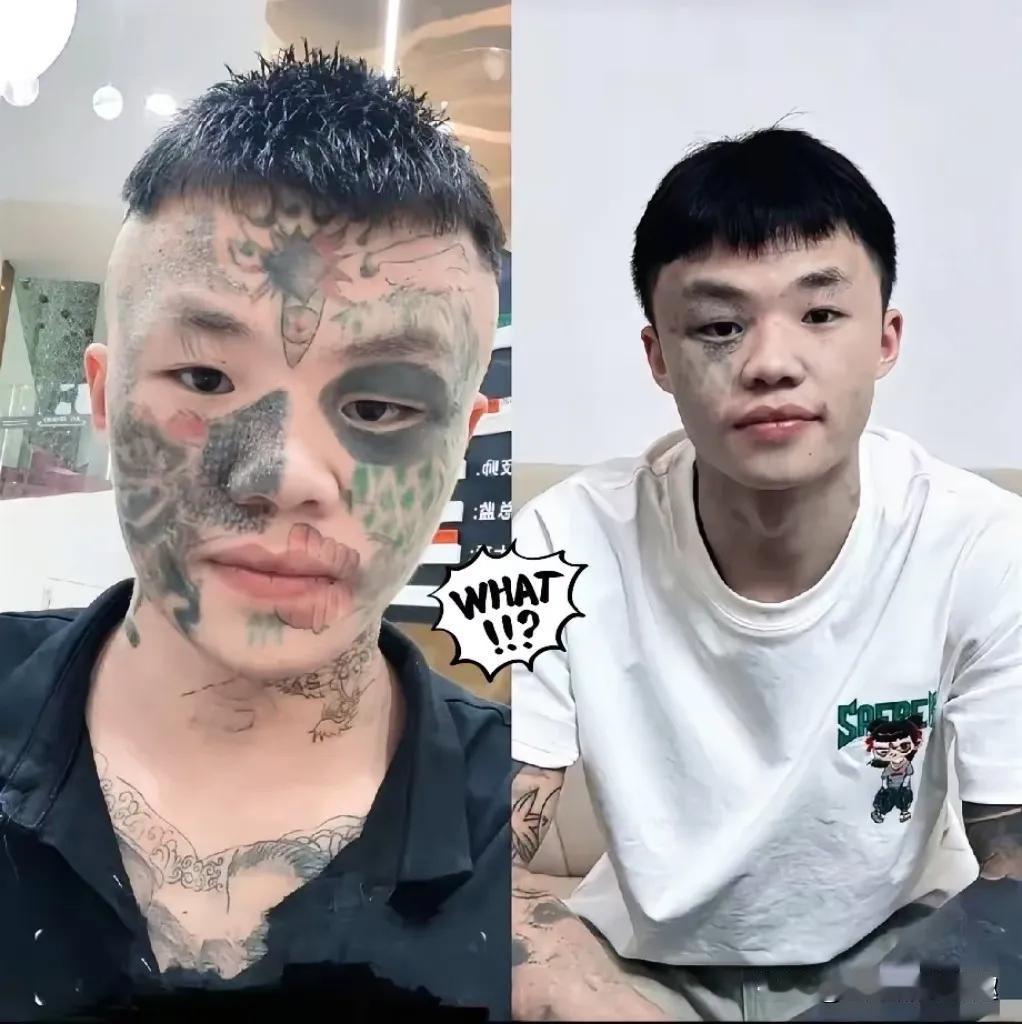 06年的广东男孩夏勇，正咬着牙挨第五次激光洗纹身——三次下来，脸上那道13岁时纹