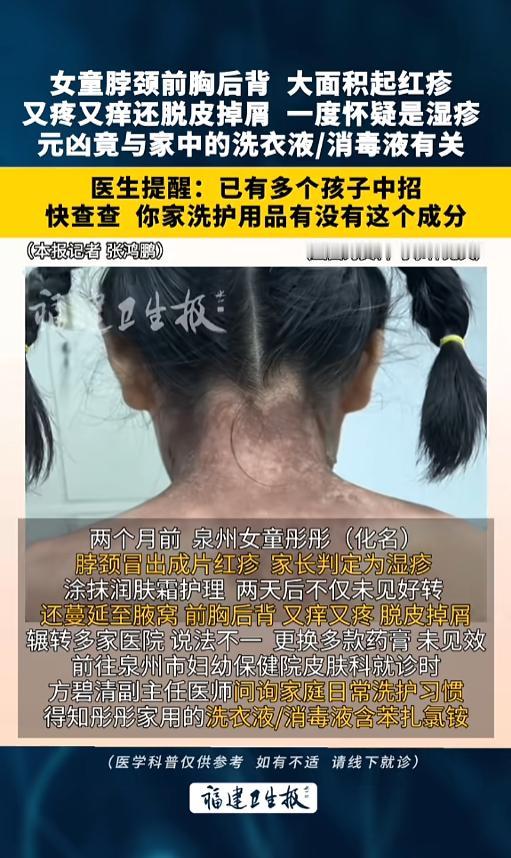 “该怎么避免呢？”7月29日报道，福建泉州，一名女童脖颈上突然起了红疹，家长给抹