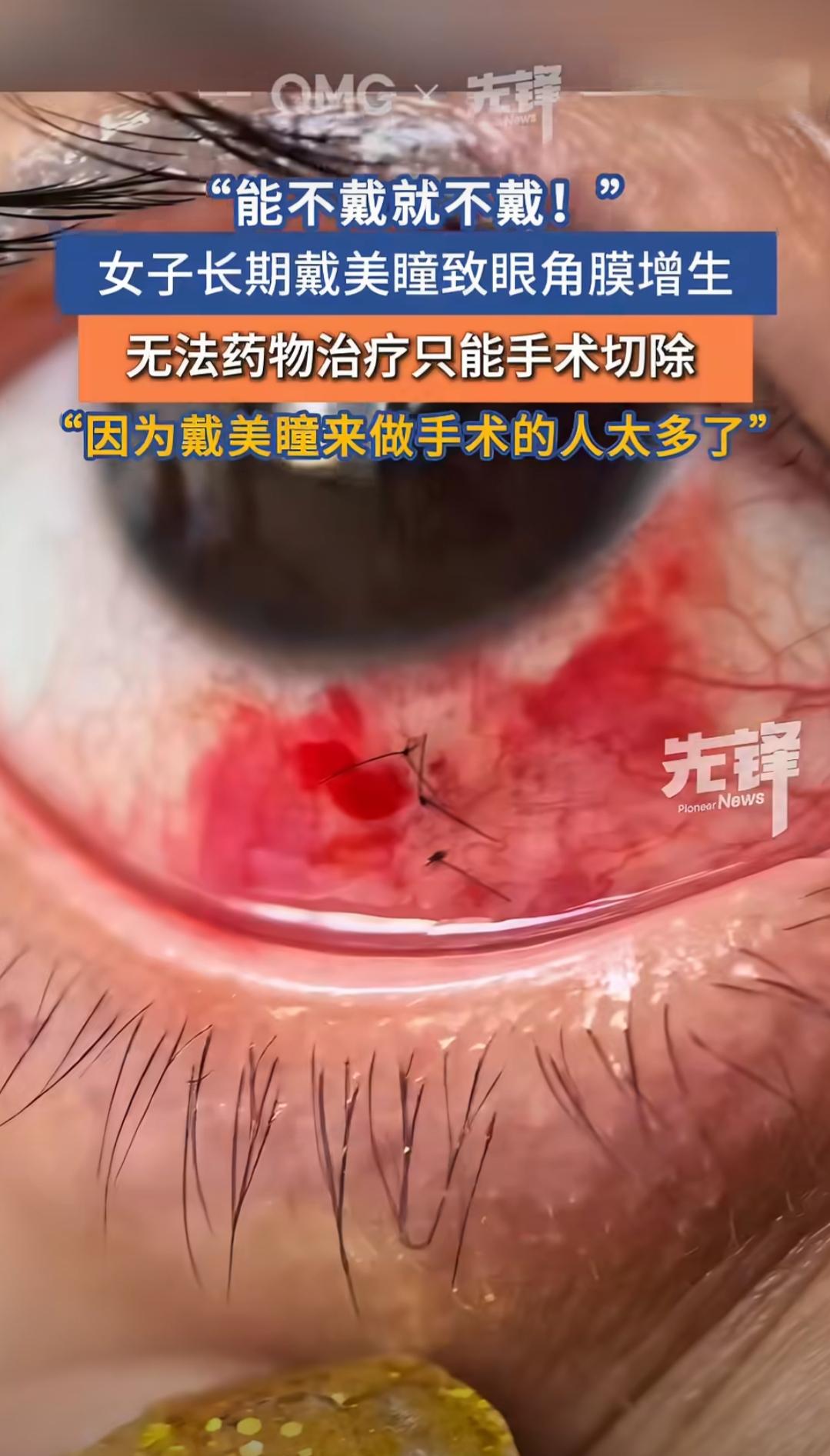 在山西太原，有个做网络主播的王女士，因为工作需要，常年得戴美瞳，这一戴就是十几年