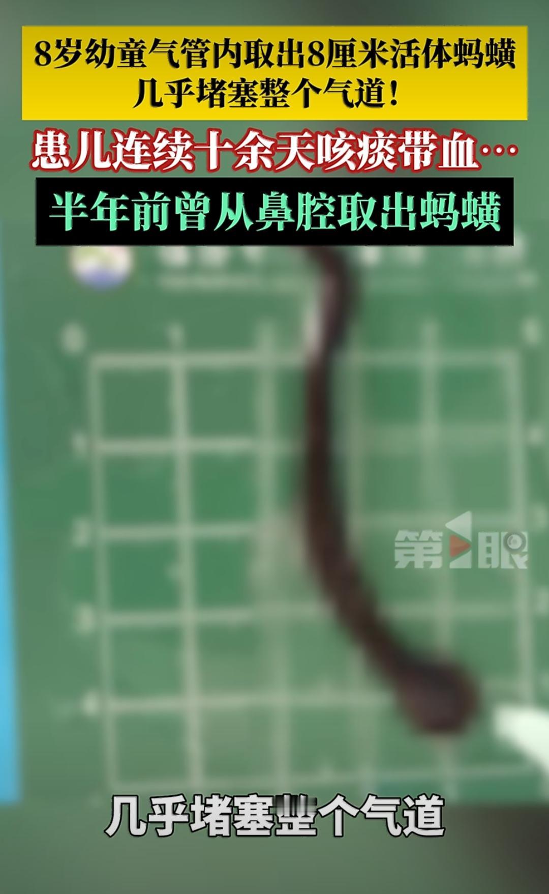 云南临沧有个8岁的小朋友，最近可遭了罪。他连续十多天咳嗽，痰里还带着血，家人赶紧