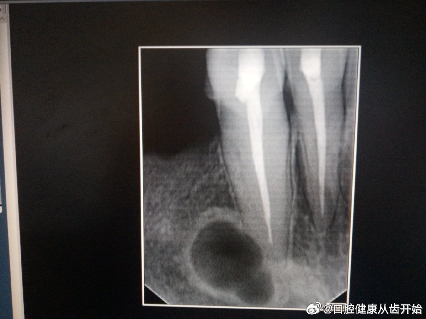 #女子6毫米结节确诊乳腺癌#广东省深圳市北京大学深圳医院做的5次手术，第1次至第3次手术做根管治疗和