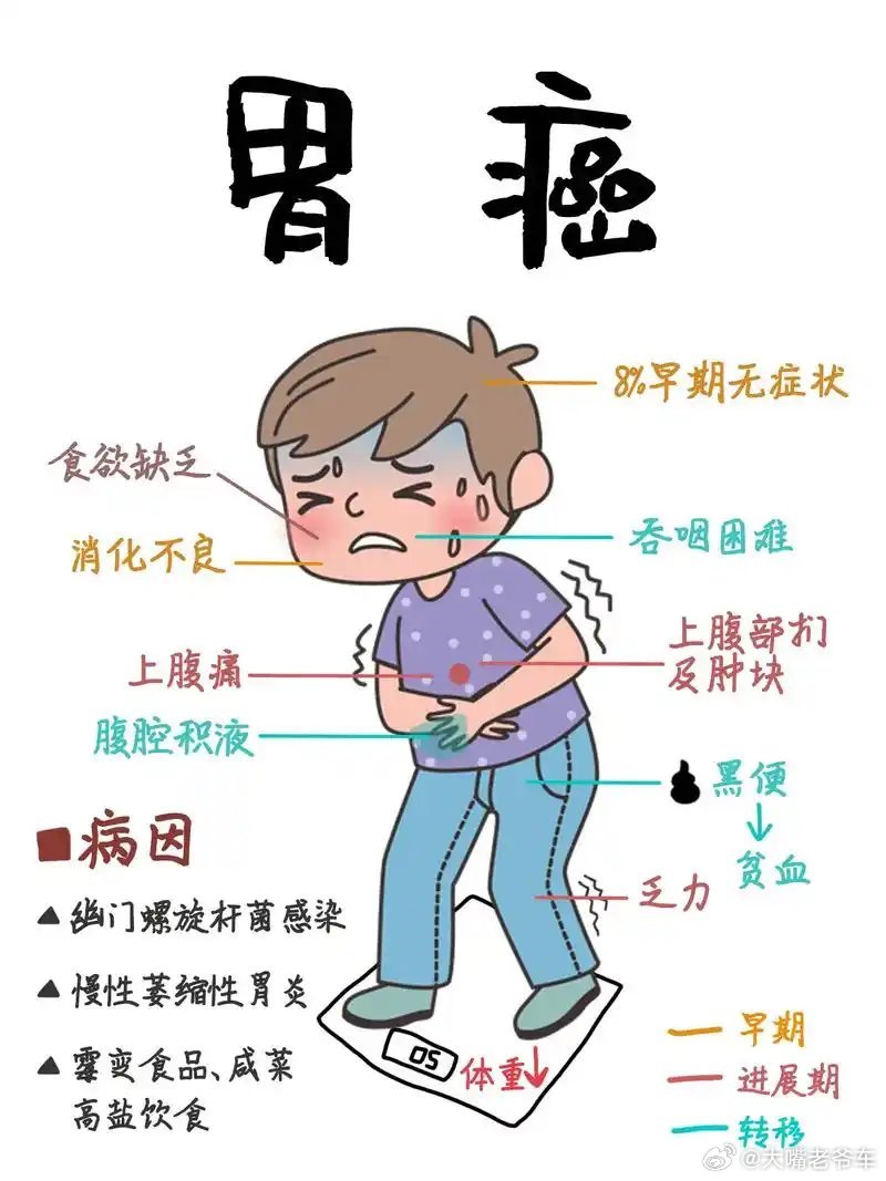 26岁确诊了早期胃癌的忠告胃病变胃癌的5个前兆1，出现持续性地胃胀、不适；2，总