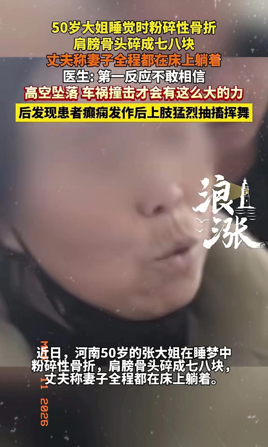 近日河南郑州，一50岁女子睡觉时竟然把自己睡成粉碎性骨折！肩膀骨头碎了七八块！丈
