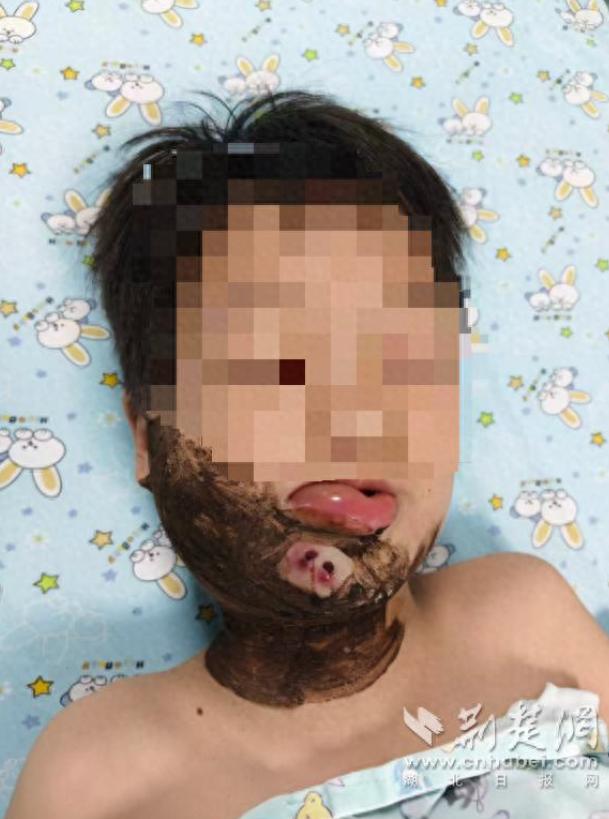 悲剧还是发生了！一名8岁男童傍晚在江边浅滩玩水时，突然被水中窜出的毒蛇咬住下唇，