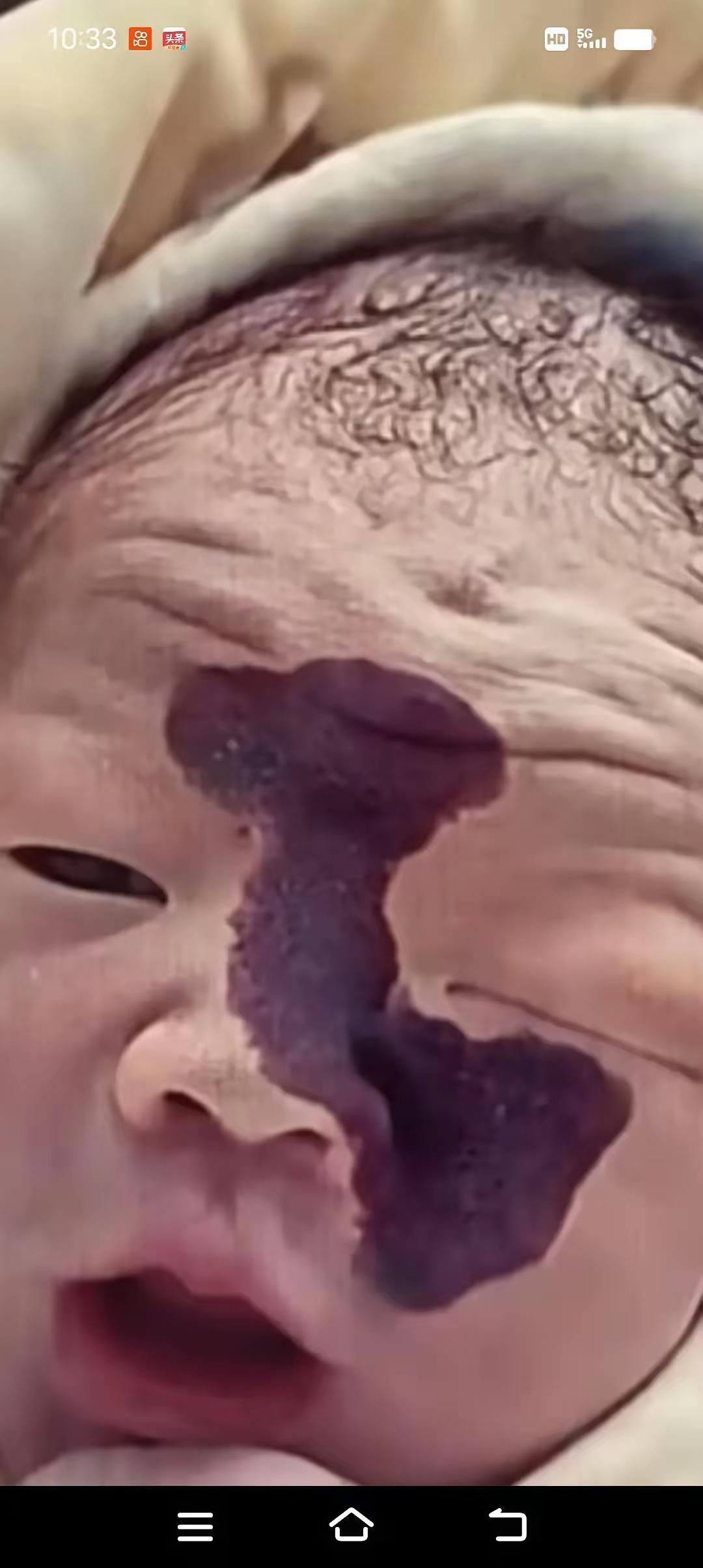 泪目！一对年轻夫妻，怀孕时在检查里看见宝宝脸上有一道黑影，医生说可能是胎记。丈夫