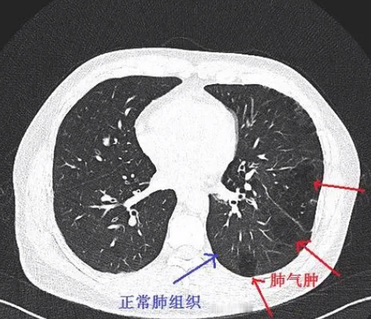 很多朋友拿到体检报告，看到“肺气肿”三个字都会特别慌张，不清楚这到底是什么疾病、