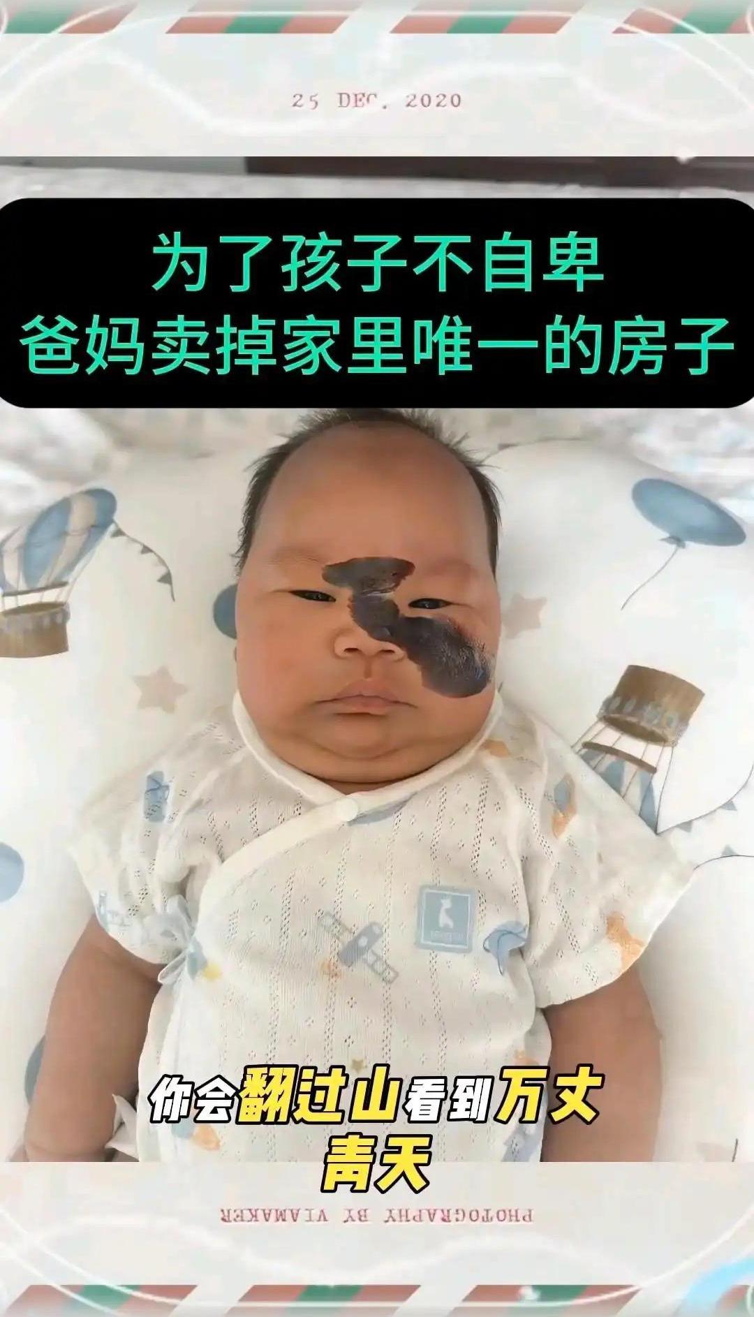 本来只是胎记，这下好了变成灰太狼这事儿真没必要啊本来孩子就一个胎记，好好的非