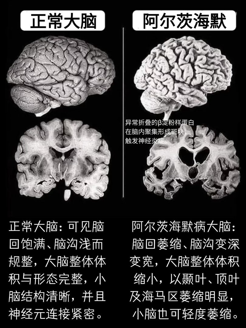 最年轻的阿尔茨海默症患者仅19岁阿尔茨海默症是怎么造成记忆衰减的？不少人发现家中