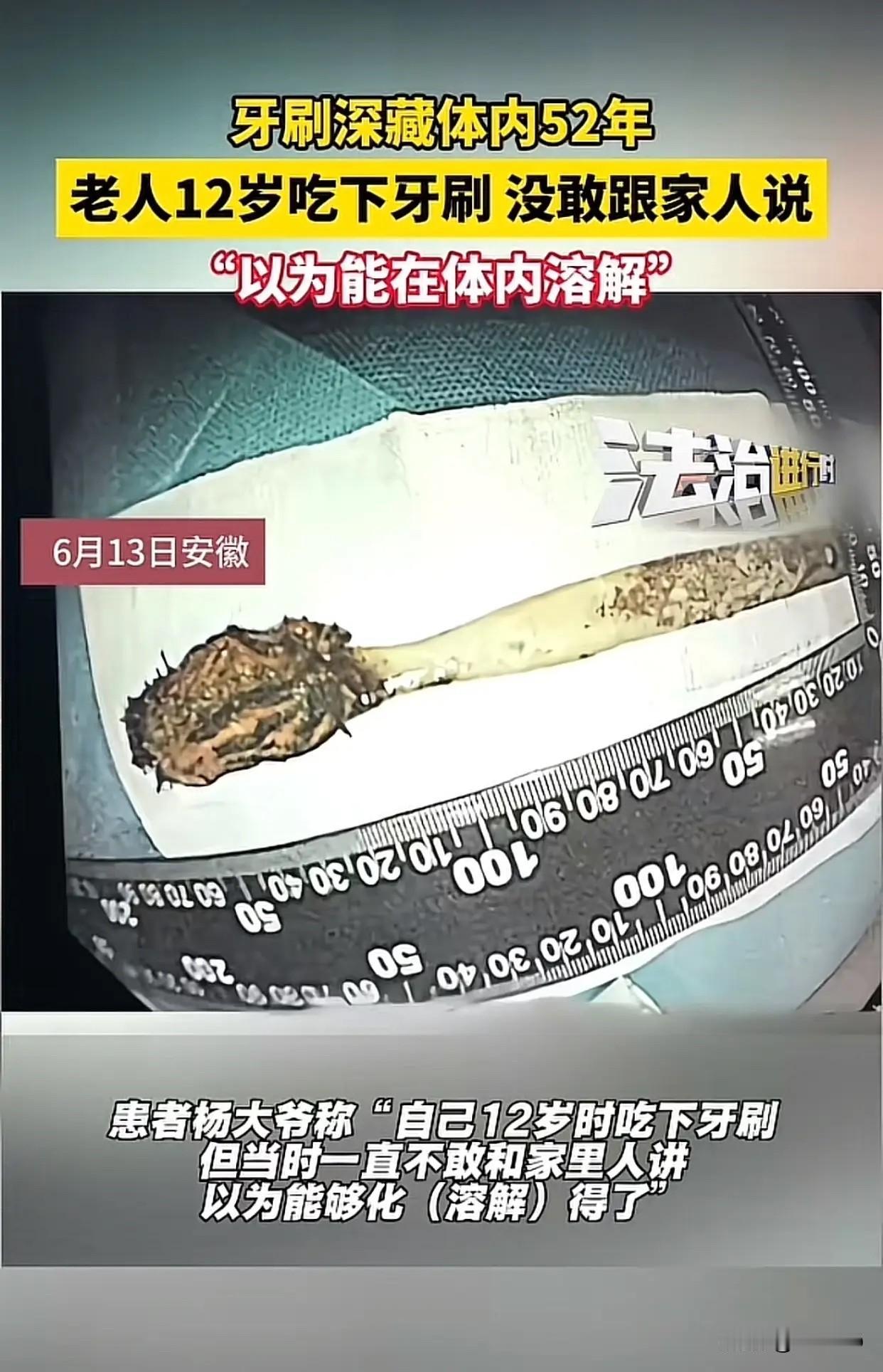 安徽六旬老汉体内惊现"古董牙刷"！52年前的一个意外，如今差点酿成大祸近