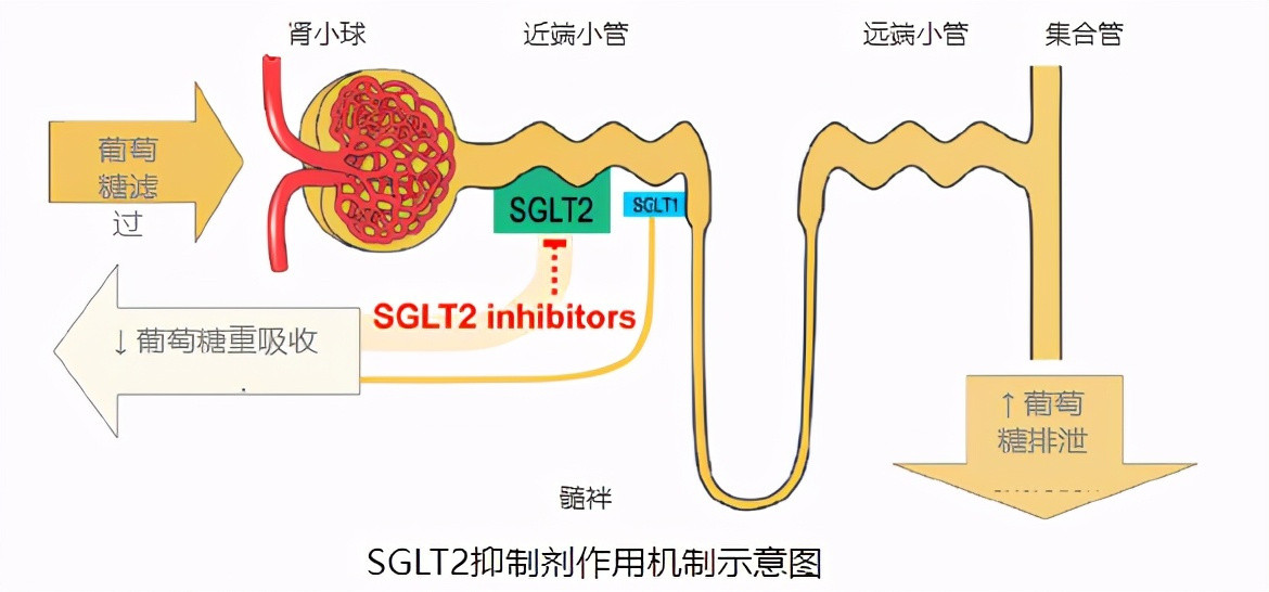 让多余的糖从肾脏漏出去是一种高明的治疗糖尿病的策略（sglt2抑制剂），对30万