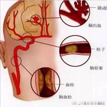 战胜脑梗不是梦！3阶段科学把握 1.脑梗塞没发生之前在脑梗还没发生时，预