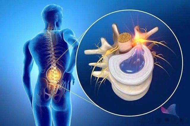 腰椎间盘突出【腰突手术科普】腰突一定要手术吗？有什么样的手术方式？如果做了手术