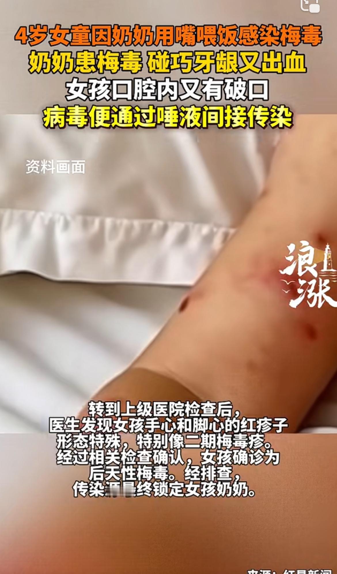 安徽一个4岁女童感染梅毒的事儿，真让人惊掉下巴。一开始孩子全身起红疹子，家长以为